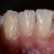 Метод регенерации или выращивания новых зубов вместо удаленных по норбекову, шичко и разработки ученых